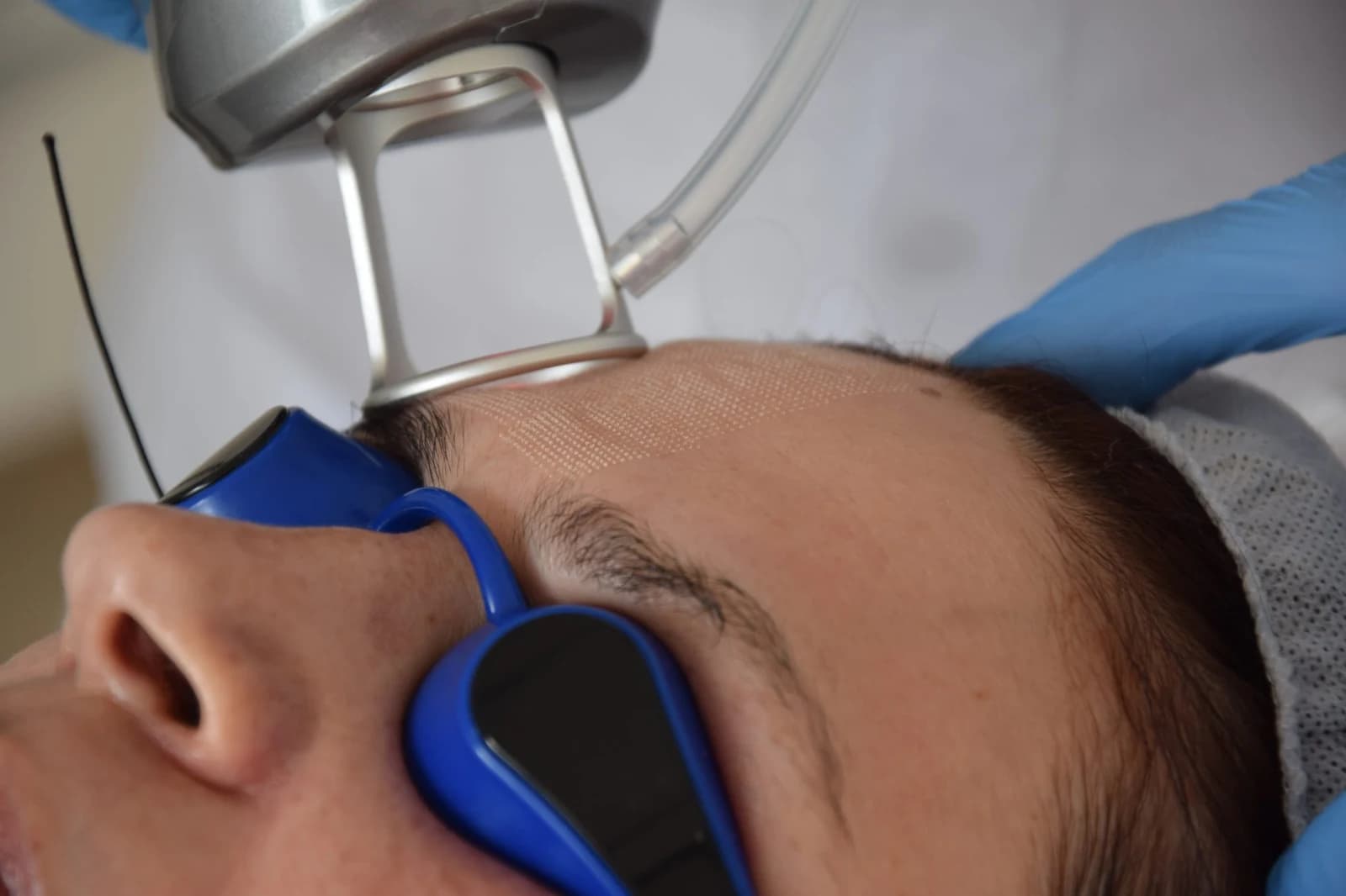 Zabieg laserem frakcyjnym CO2 w MMClinic we Wrocławiu