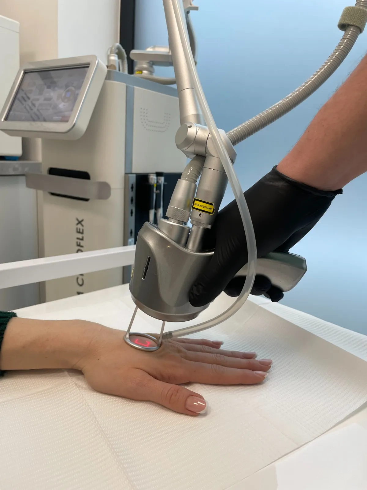 Photorejuvenation der Hände
