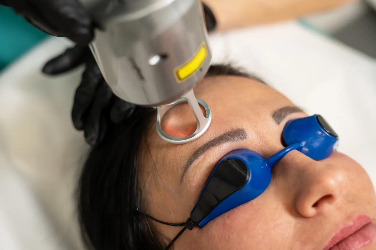 Fraktionierter Laser: Gesicht + Hals gratis