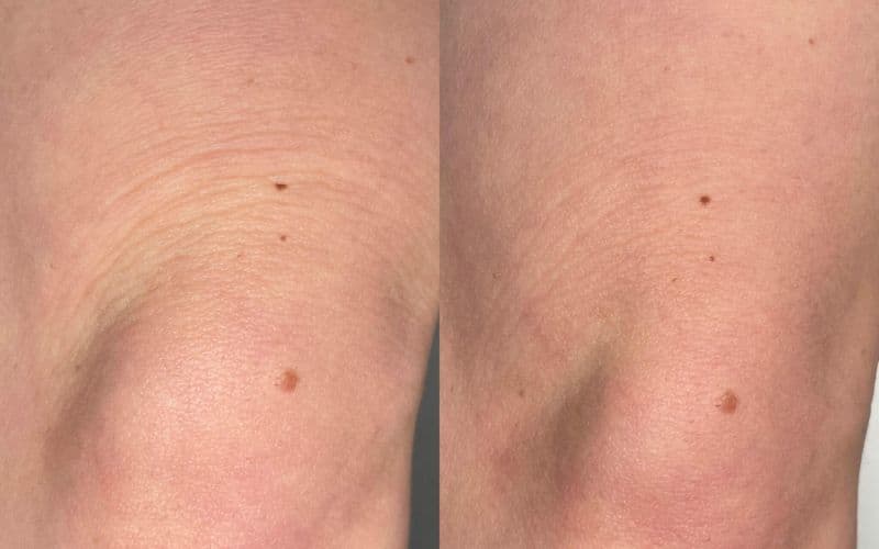 Microneedling-Radiofrequenz oder Dermapen? Ein umfassender Vergleich der Verjüngungstechnologien