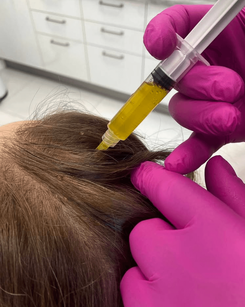 Podanie osocza bogatopłytkowego w owłosioną skórę głowy w MMClinic