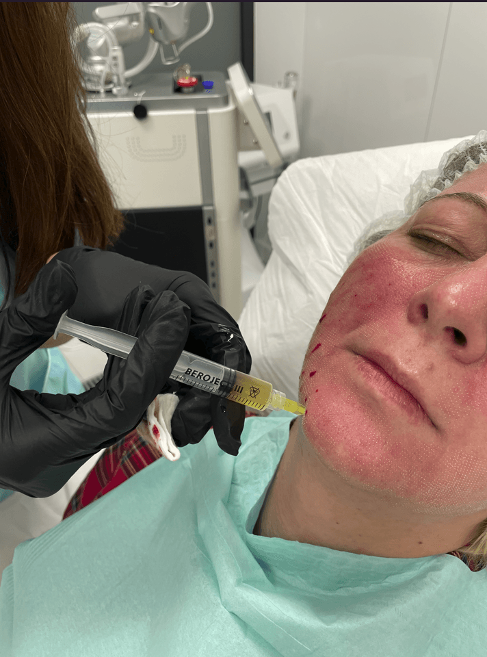 Podanie osocza bogatopłytkowego w skórę twarzy w MMClinic