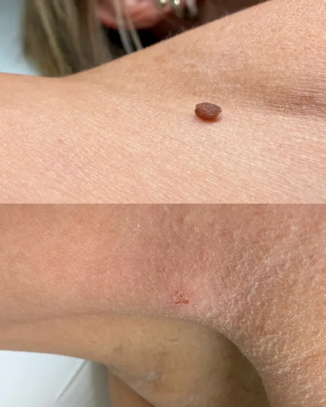 Laserentfernung eines weichen Fibroms in der Achsel – vor dem Eingriff (oben) und unmittelbar danach (unten). Durchgeführt von Arzt Michał Marciniak, MMClinic Wrocław.
