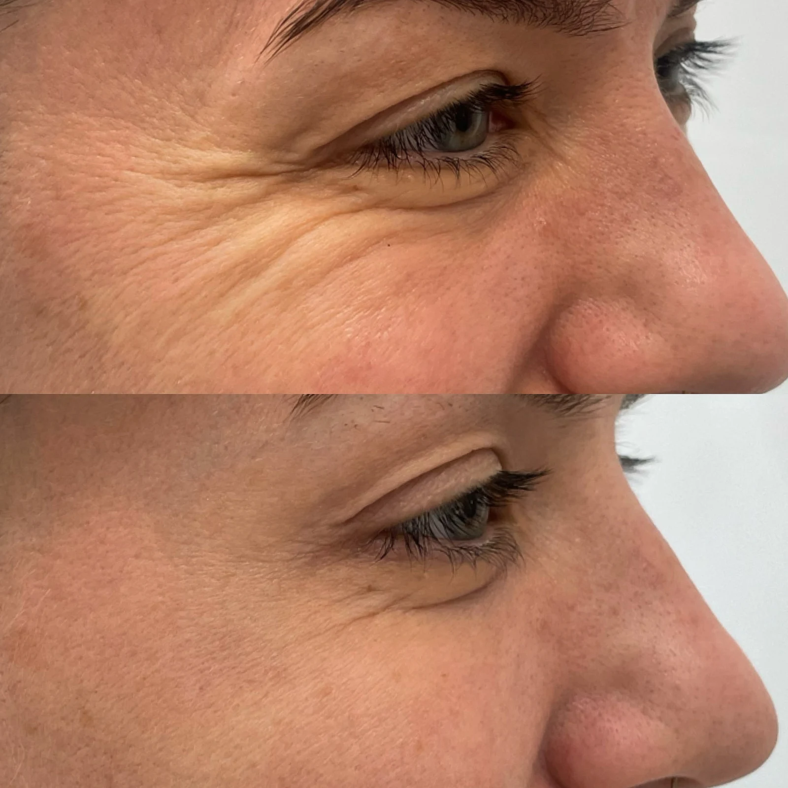 botulinum toxin for wrinkles around the eyes