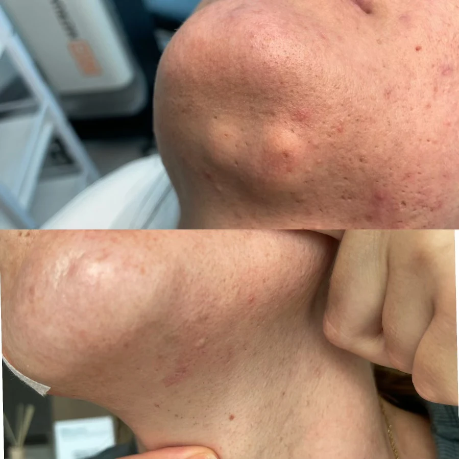 surgical removal of sebaceous cysts