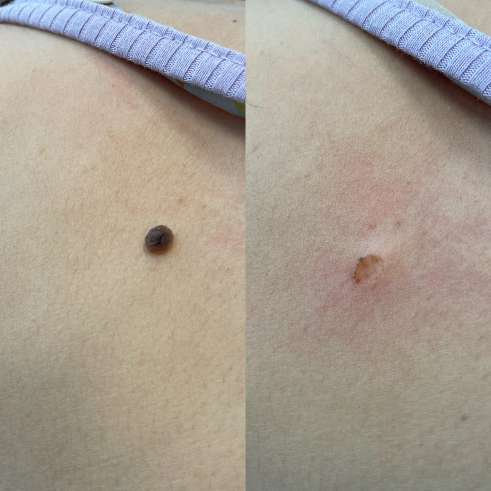 laser removal of a skin lesion - immediately after the treatment