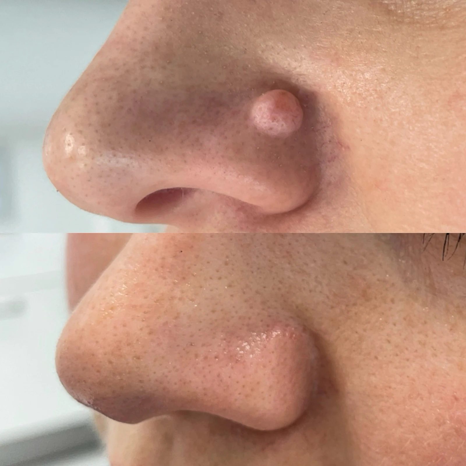 laser removal of skin lesions