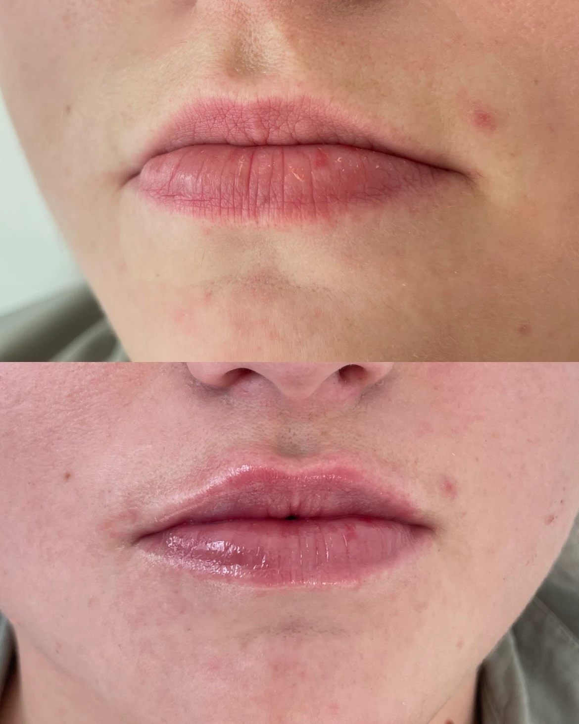 lip contouring
