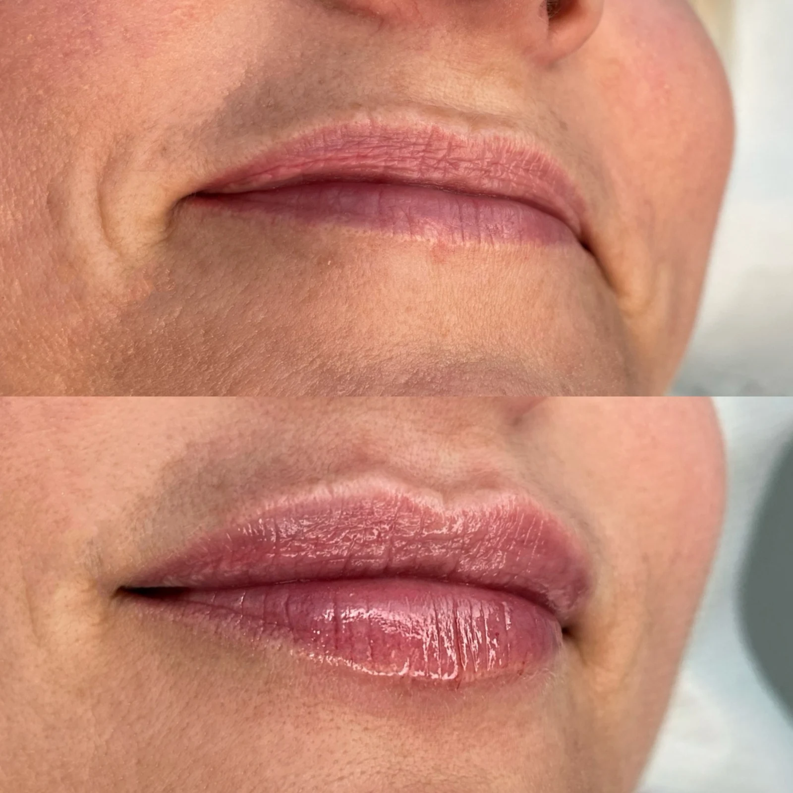 lip contouring