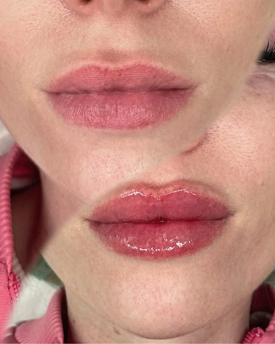 lip contouring