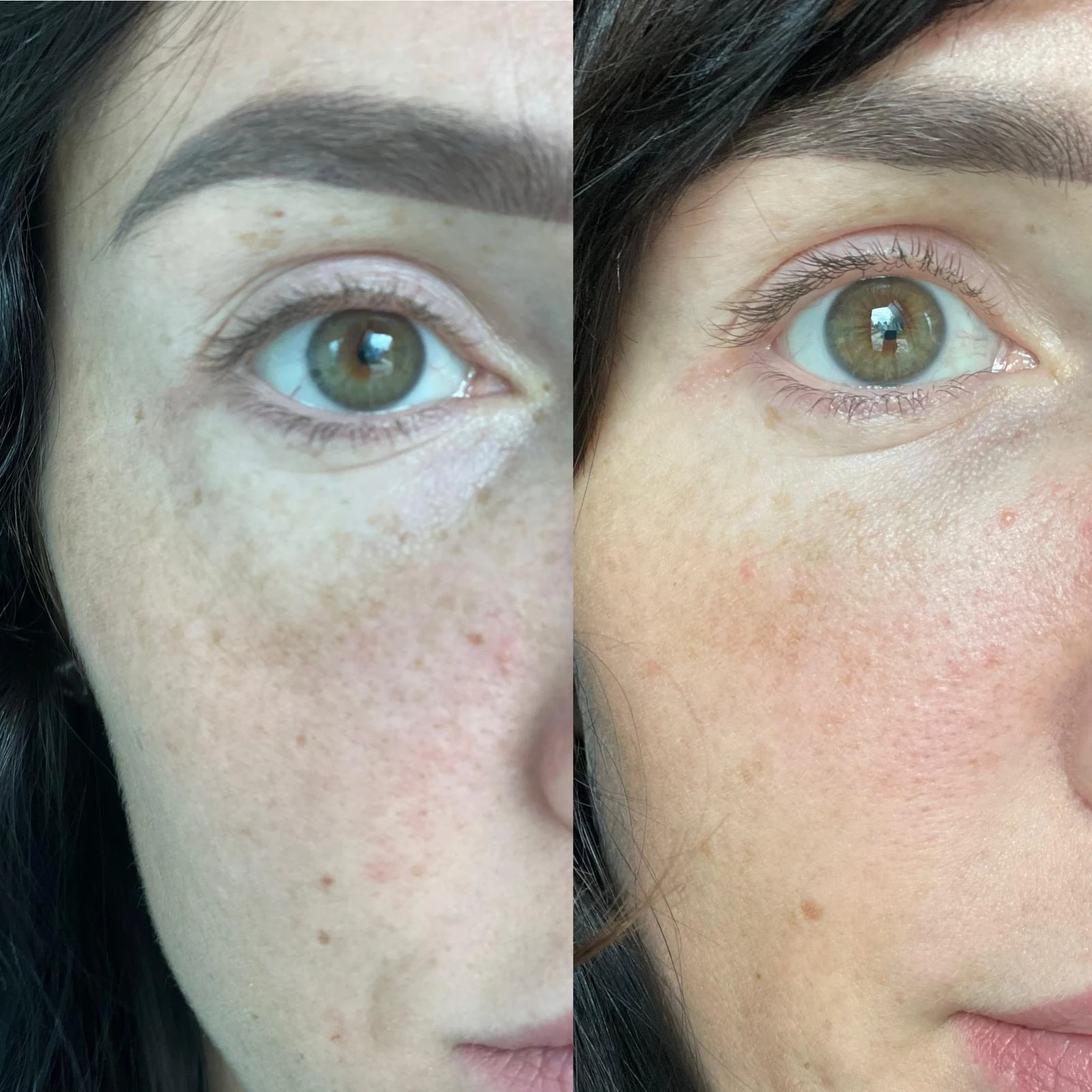 microneedle radiofrequency