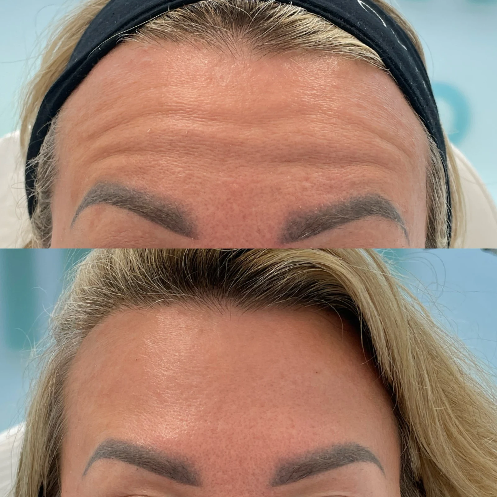 botulinum toxin for forehead lines