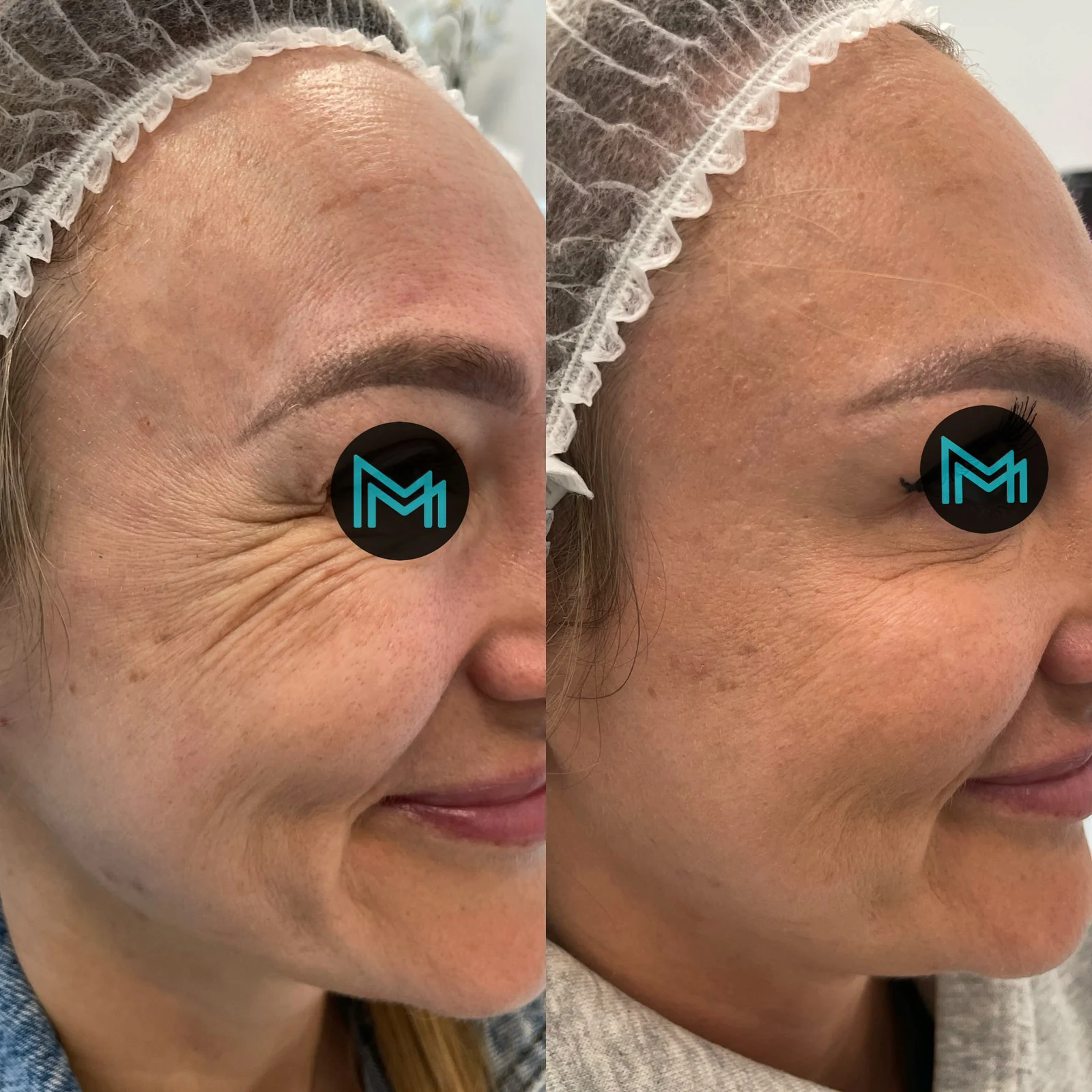botulinum toxin for wrinkles around the eyes