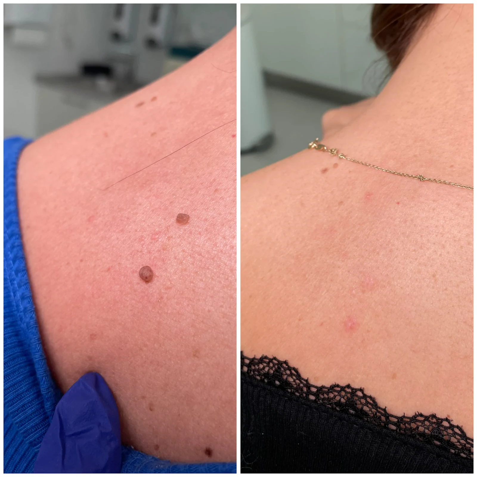 laser removal of skin lesions