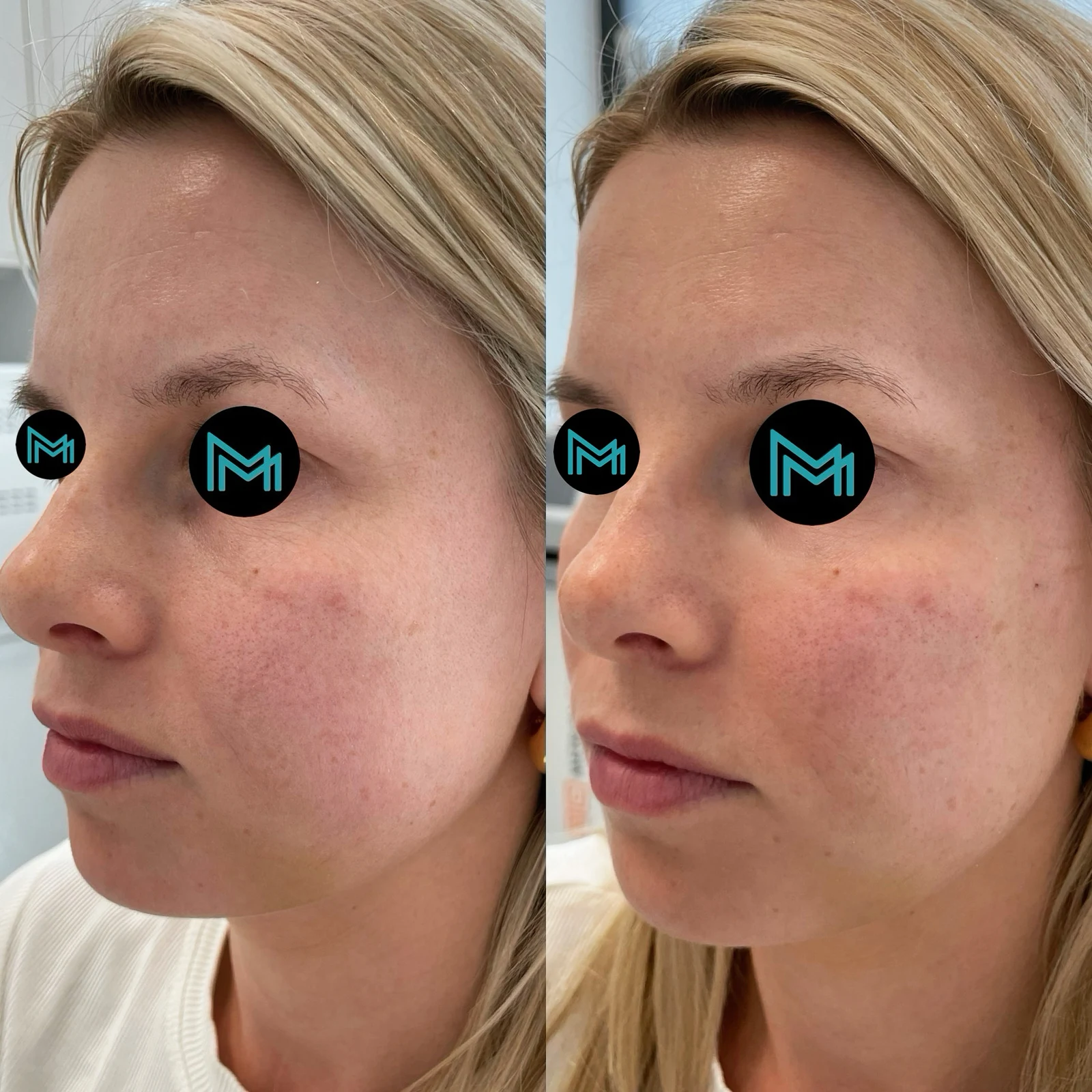 tear trough correction
