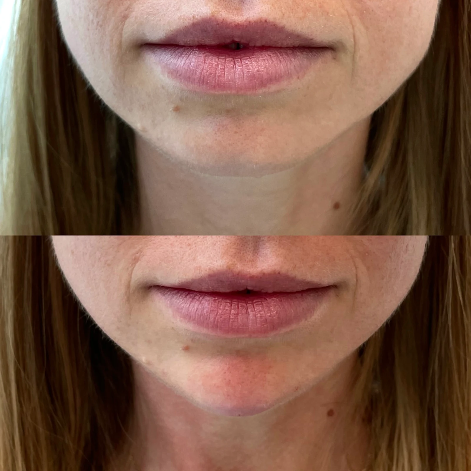 Lippenvergrößerung mit Hyaluronsäure – Ergebnis vor und nach der Behandlung