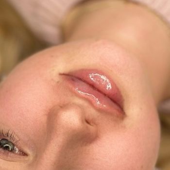 Modelowanie ust – jak o nie dbać po zabiegu? Porady i zalecenia