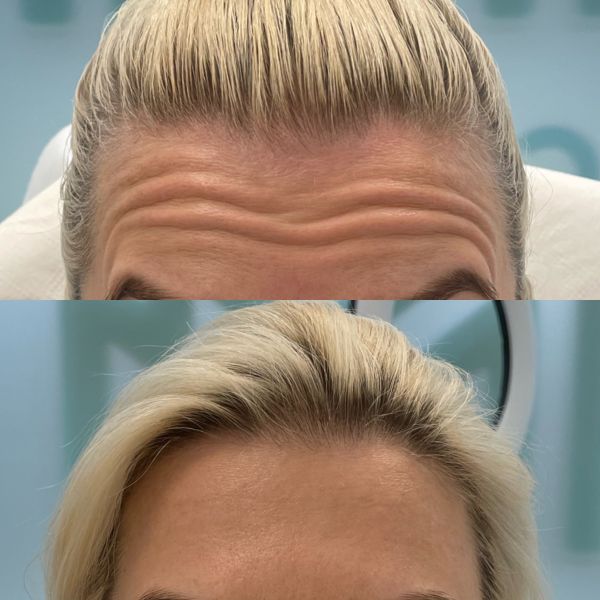 toksyna botulinowa czoło