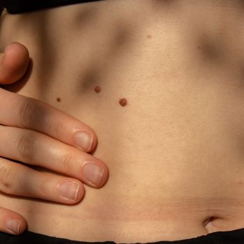 Jak rozpoznać niebezpieczne zmiany skórne?