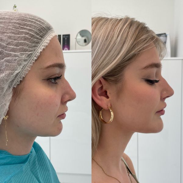 kwas hialuronowy - poprawa dolnego piętra twarzy