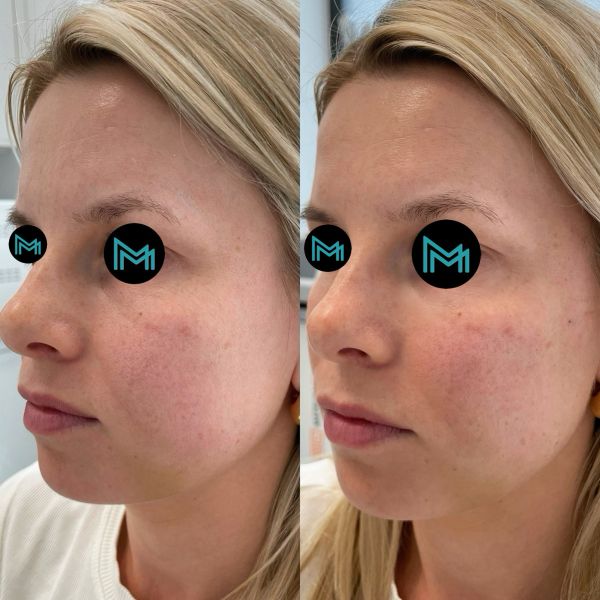 usunięcie doliny łez