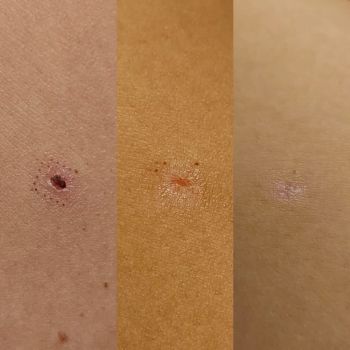 Wypalanie znamion — co to takiego?