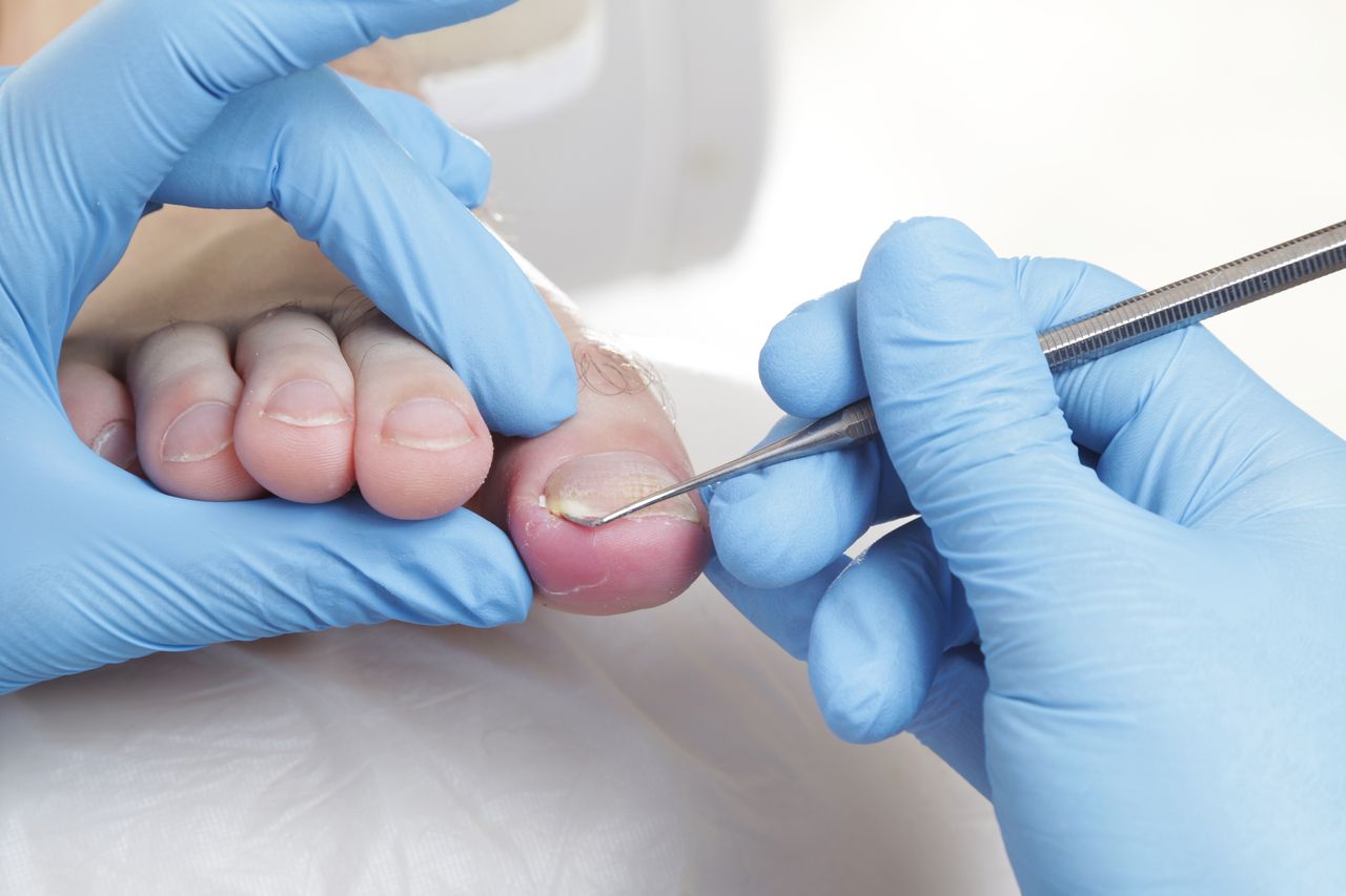 Chirurgiczne usuwanie wrastajacych paznokci