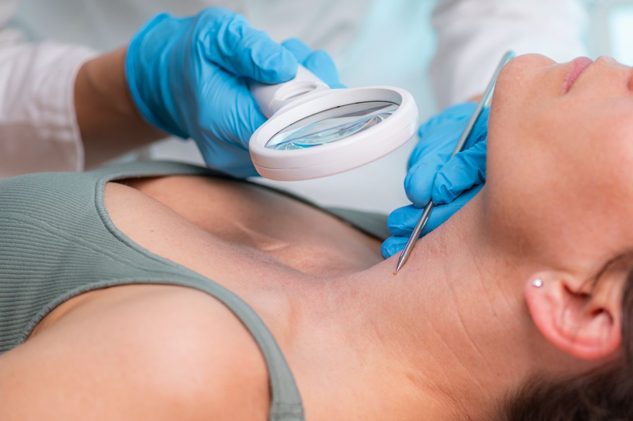 Chirurgiczne usuwanie kaszaków