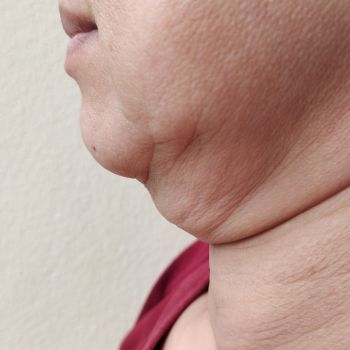 Lipoliza – Rewolucyjna metoda modelowania sylwetki