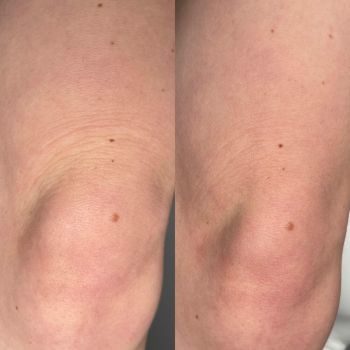 Radiofrekwencja mikroigłowa czy Dermapen? Kompletne porównanie technologii odmładzających