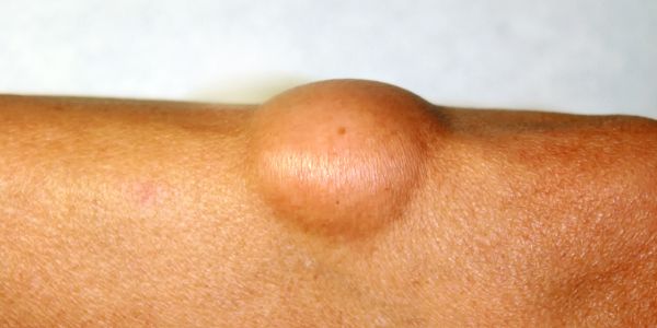 Chirurgiczne usuwanie tłuszczaków Wrocław