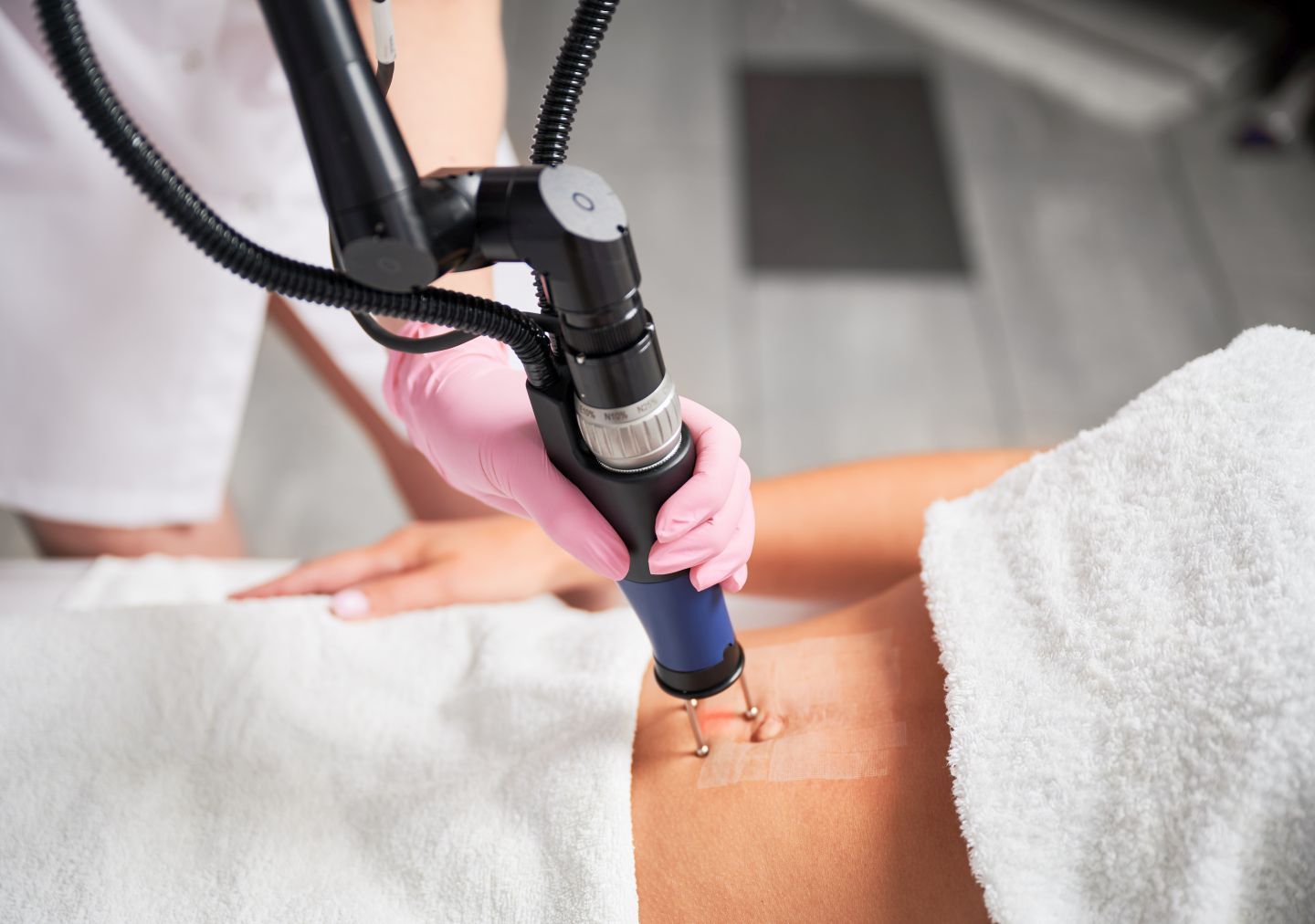 Laserowe usuwanie rozstępów 