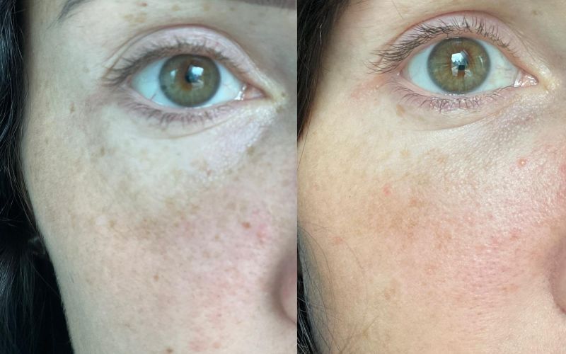 Czy radiofrekwencja mikroigłowa boli? Prawda o bezpieczeństwie, znieczuleniu i zabiegach latem