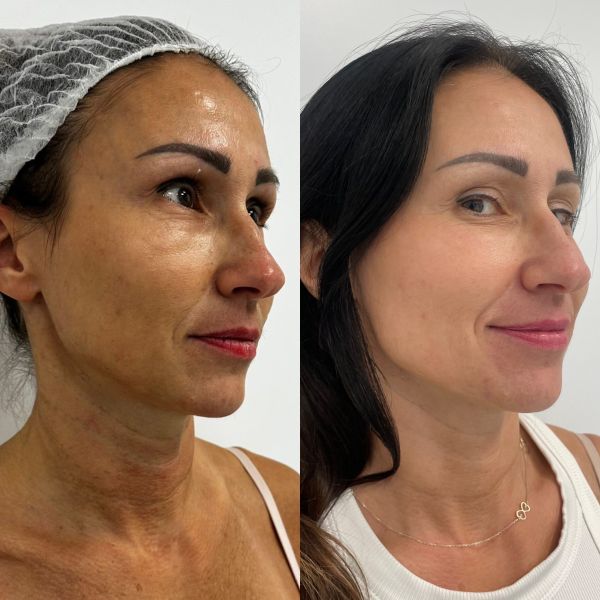 laser frakcyjny co2 wrocław