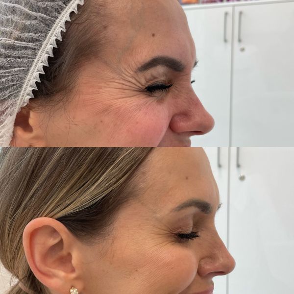 toksyna botulinowa na kurze łapki