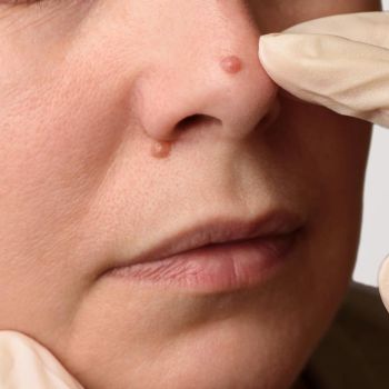 Pieprzyki – jak powstają i jak je usunąć