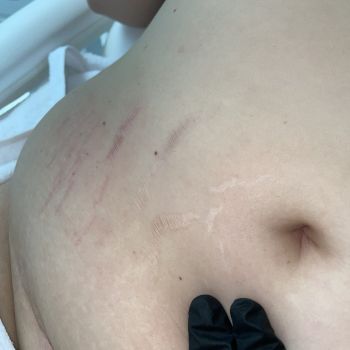 Leczenie blizn i rozstępów osoczem bogatopłytkowym