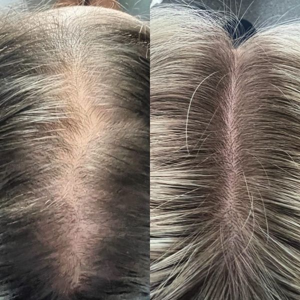 trychologiczne leczenie łysienia