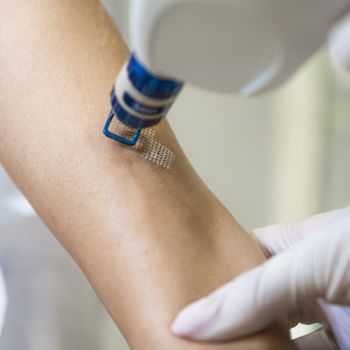 Laserowe usuwanie blizn – jak działa i czego się spodziewać?