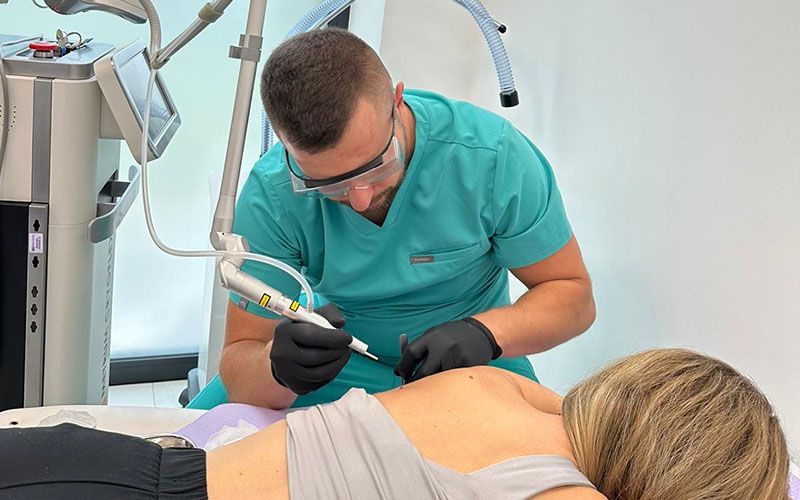 laserowe wypalanie pieprzyków z wykorzystanie lasera frakcyjnego CO2