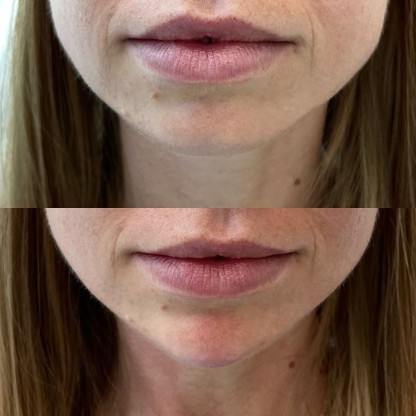 modelowanie brody kwasem hialuronowym