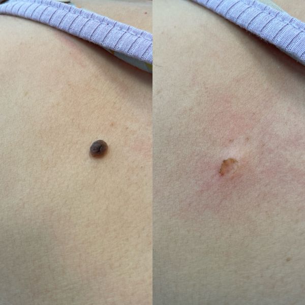 laserowe usunięcie zmiany skórnej- bezpośrednio po zabiegu
