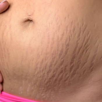 Laserowe usuwanie blizn – dlaczego warto zdecydować się na zabieg?