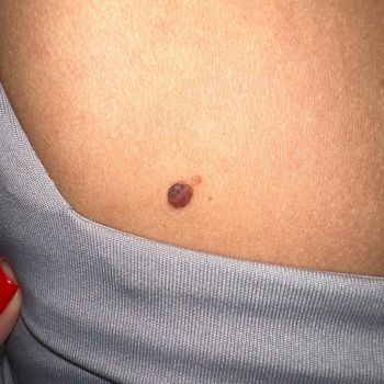 Kiedy pieprzyki mogą być groźne?