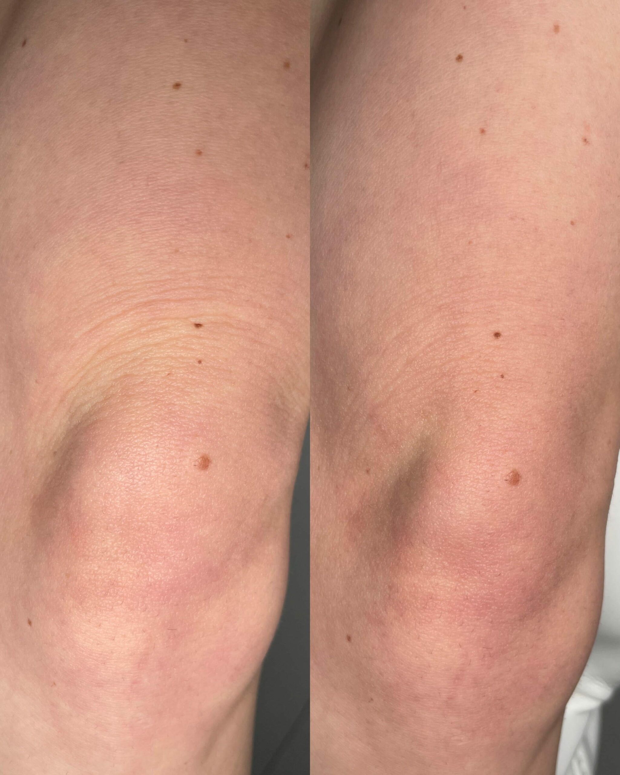 Radiofrekwencja mikroigłowa czy Dermapen? Kompletne porównanie technologii odmładzających