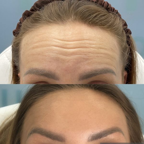 toksyna botulinowa na zmarszczki czoła