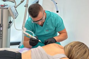 laserowe wypalanie pieprzyków z wykorzystanie lasera frakcyjnego CO2