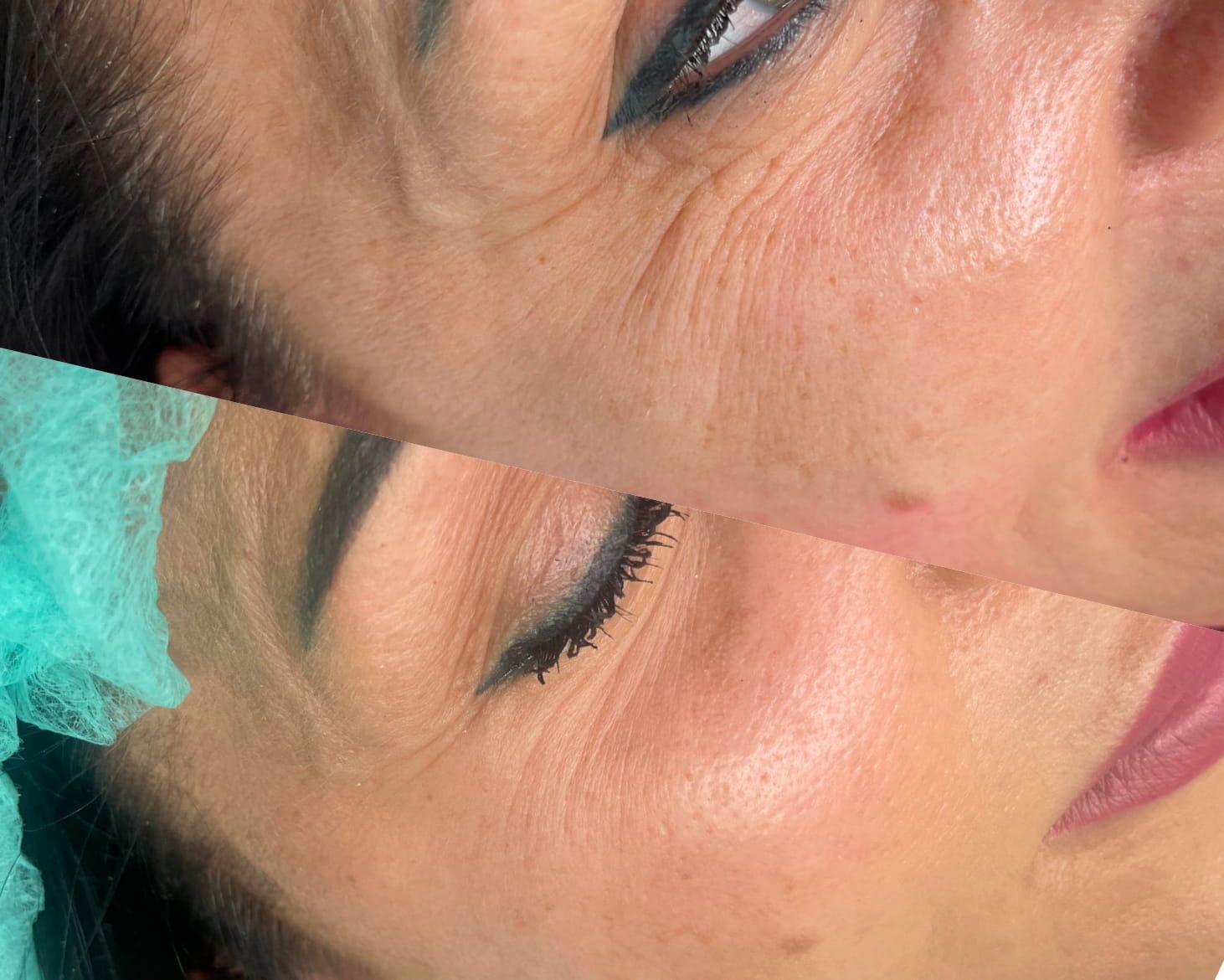 Jak działa radiofrekwencja mikroigłowa? Mechanizm przebudowy kolagenu, technologia frakcyjna i rodzaje igieł