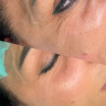 Jak działa radiofrekwencja mikroigłowa? Mechanizm przebudowy kolagenu, technologia frakcyjna i rodzaje igieł