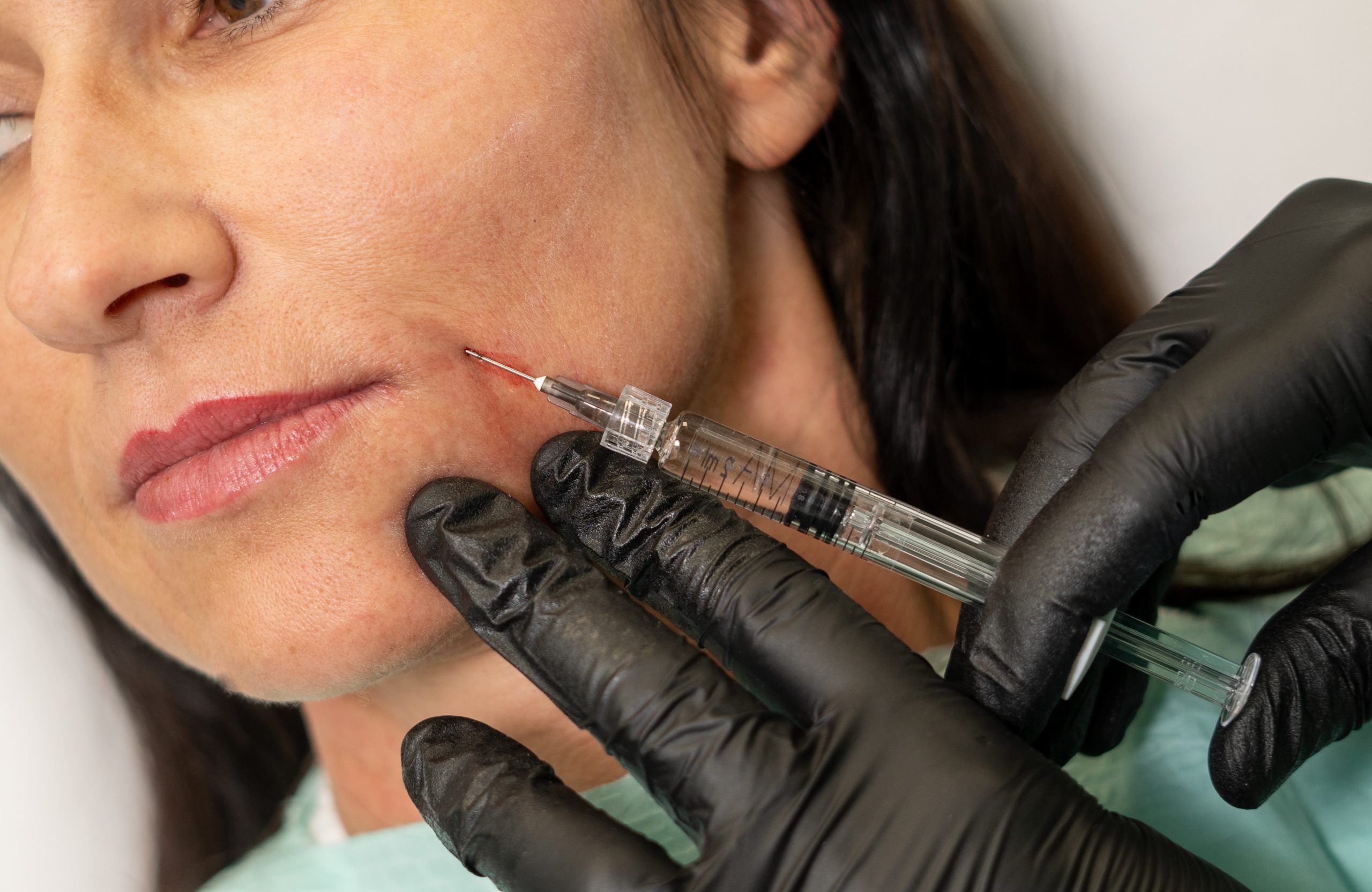 Wypełnianie kwasem hialuronowym